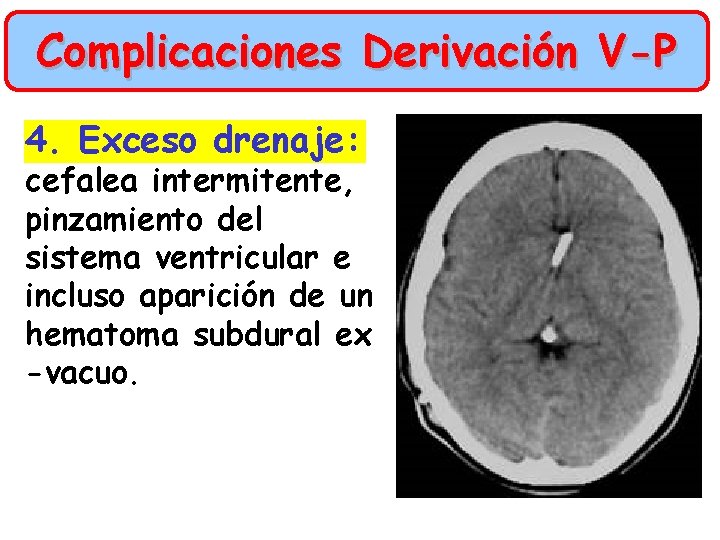 Complicaciones Derivación V-P 4. Exceso drenaje: cefalea intermitente, pinzamiento del sistema ventricular e incluso