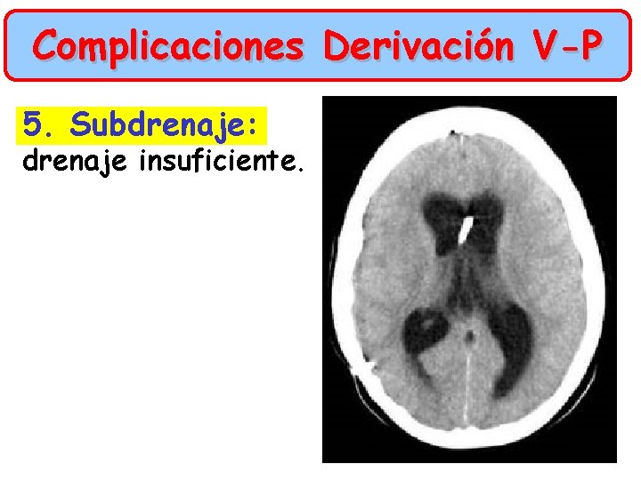 Complicaciones Derivación V-P 5. Subdrenaje: drenaje insuficiente. 