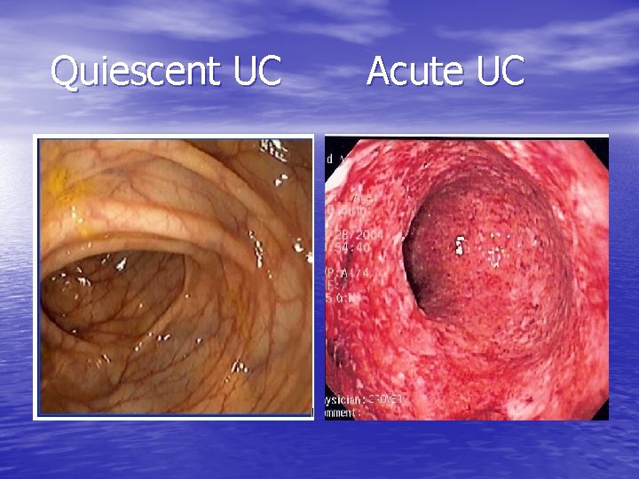 Quiescent UC Acute UC 