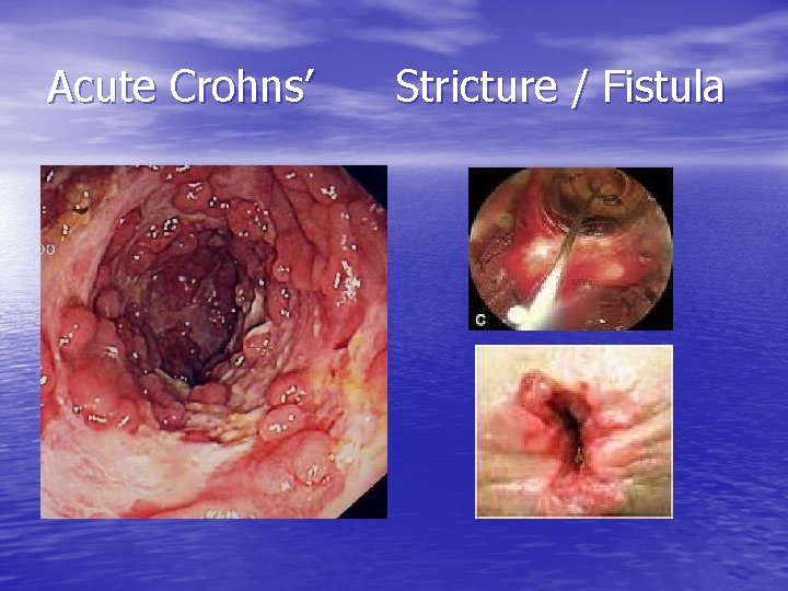 Acute Crohns’ Stricture / Fistula 