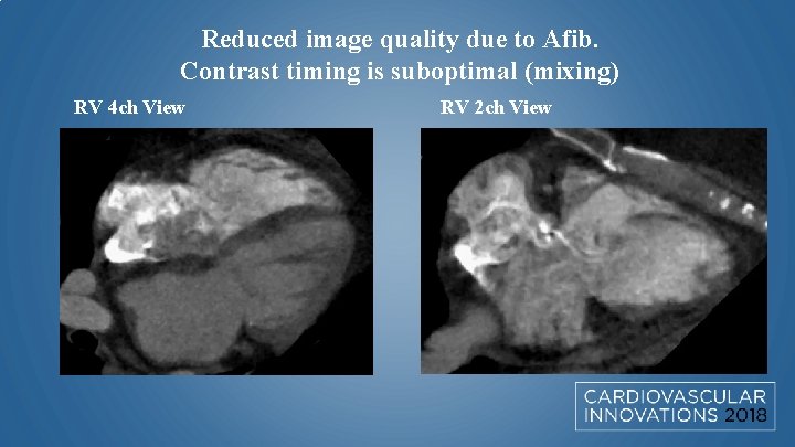 Reduced image quality due to Afib. Contrast timing is suboptimal (mixing) RV 4 ch