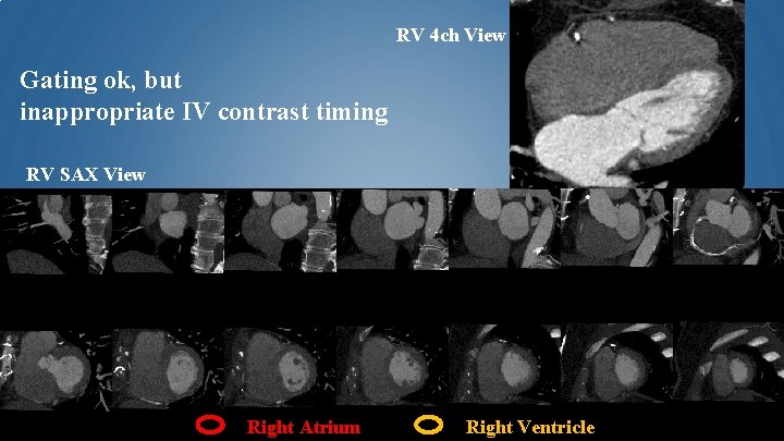 RV 4 ch View Gating ok, but inappropriate IV contrast timing RV SAX View