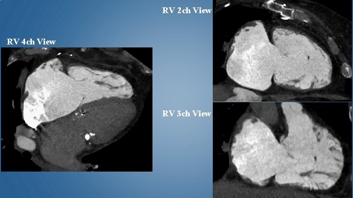 RV 2 ch View RV 4 ch View RV 3 ch View 