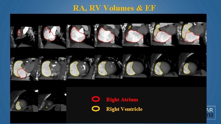 RA, RV Volumes & EF RV SAX View Right Atrium Right Ventricle 
