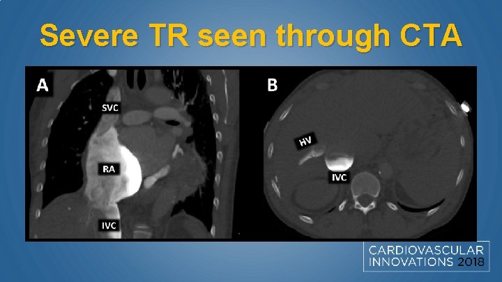 Severe TR seen through CTA 