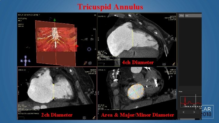 Tricuspid Annulus 4 ch Diameter 2 ch Diameter Area & Major/Minor Diameter 