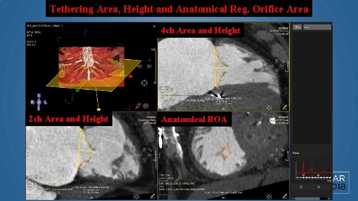 Tethering Area, Height and Anatomical Reg. Orifice Area 4 ch Area and Height 2
