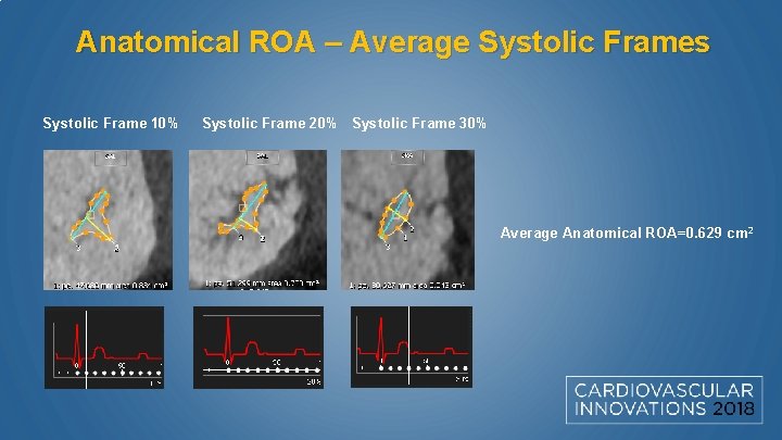 Anatomical ROA – Average Systolic Frames Systolic Frame 10% Systolic Frame 20% Systolic Frame