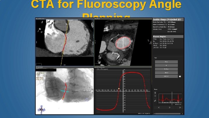 CTA for Fluoroscopy Angle Planning 