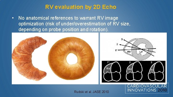 RV evaluation by 2 D Echo • No anatomical references to warrant RV image