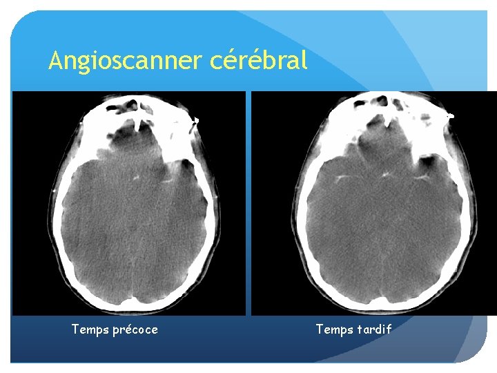 Angioscanner cérébral Temps précoce Temps tardif 