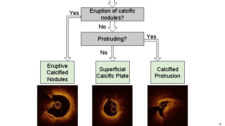 Yes Eruption of calcific nodules? No Protruding? Yes No Eruptive Calcified Nodules Superficial Calcific Yes Eruption of calcific nodules? No Protruding? Yes No Eruptive Calcified Nodules Superficial Calcific