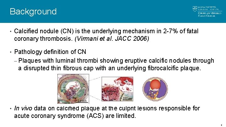 Background • Calcified nodule (CN) is the underlying mechanism in 2 -7% of fatal Background • Calcified nodule (CN) is the underlying mechanism in 2 -7% of fatal