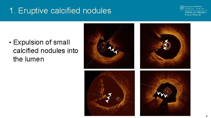 1. Eruptive calcified nodules • Expulsion of small calcified nodules into the lumen 5 1. Eruptive calcified nodules • Expulsion of small calcified nodules into the lumen 5