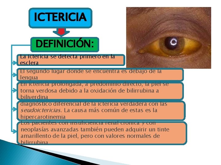 ICTERICIA DEFINICIÓN: La ictericia se detecta primero en la esclera El segundo lugar donde ICTERICIA DEFINICIÓN: La ictericia se detecta primero en la esclera El segundo lugar donde