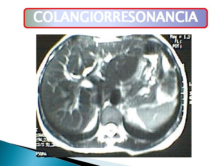 COLANGIORRESONANCIA COLANGIORRESONANCIA