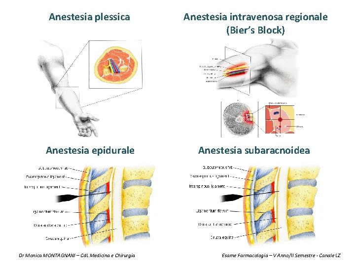 Anestesia plessica Anestesia intravenosa regionale (Bier’s Block) Anestesia epidurale Anestesia subaracnoidea Dr Monica MONTAGNANI