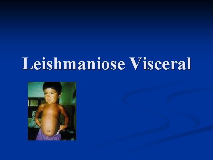 Leishmaniose Visceral 