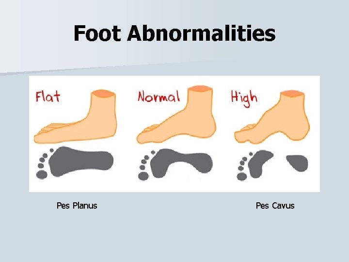 Foot Abnormalities Planus Pes Cavus 