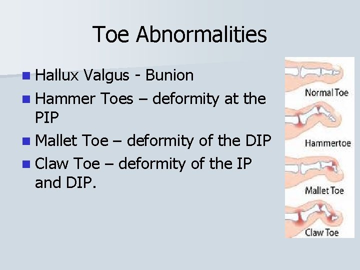 Toe Abnormalities n Hallux Valgus - Bunion n Hammer Toes – deformity at the