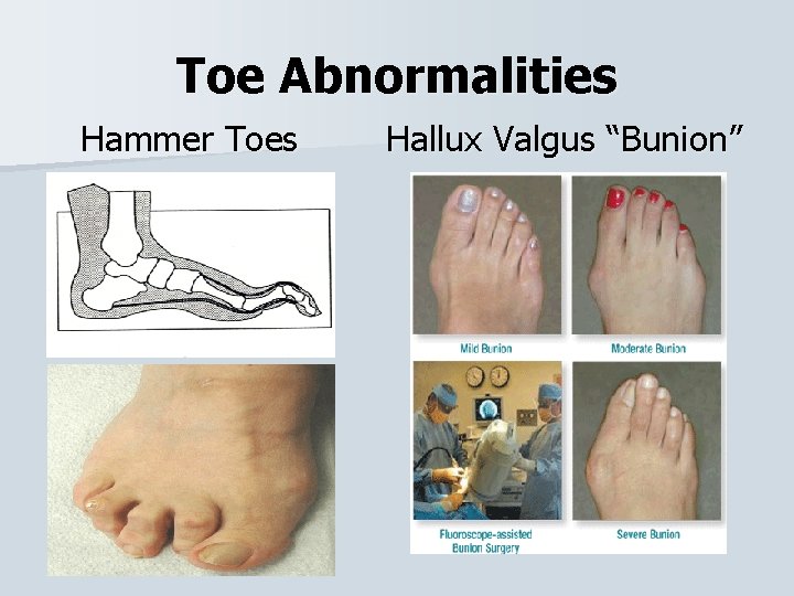 Toe Abnormalities Hammer Toes Hallux Valgus “Bunion” 