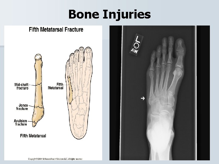 Bone Injuries 