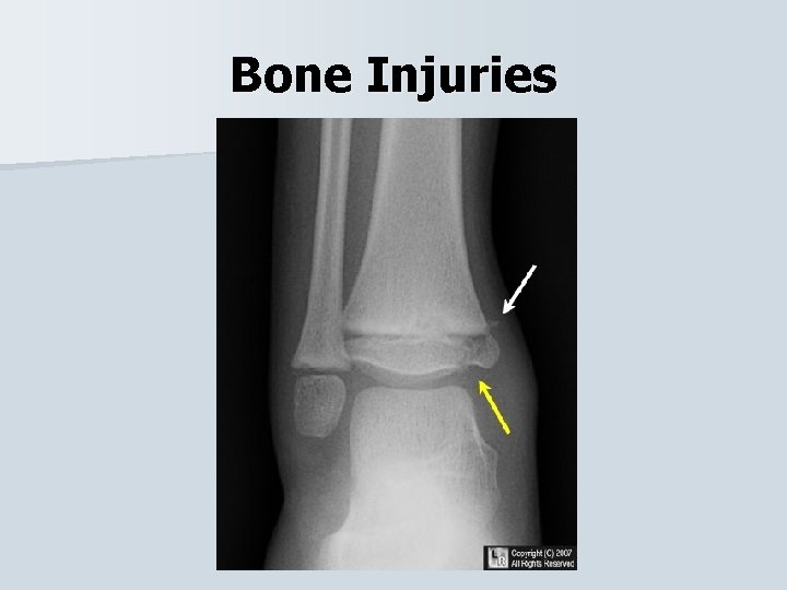 Bone Injuries 