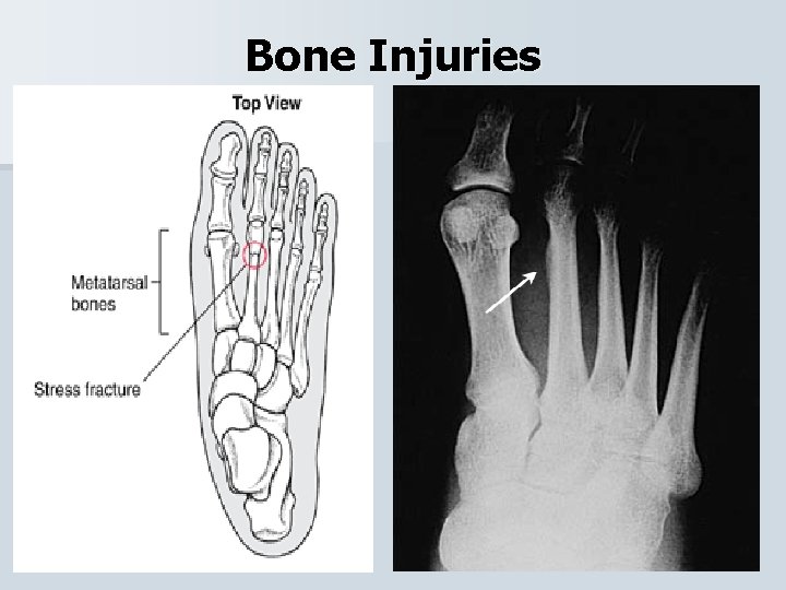 Bone Injuries 