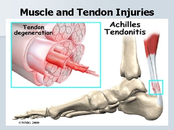 Muscle and Tendon Injuries 