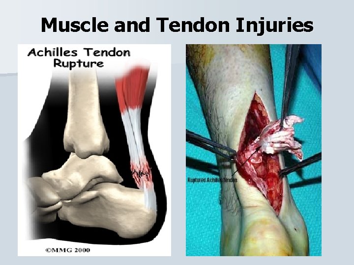 Muscle and Tendon Injuries 