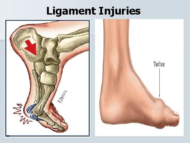 Ligament Injuries 