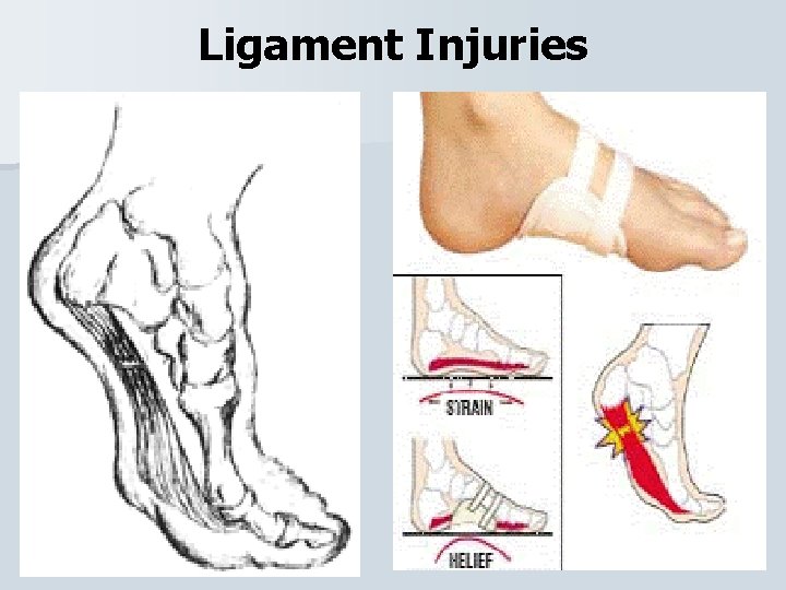 Ligament Injuries 