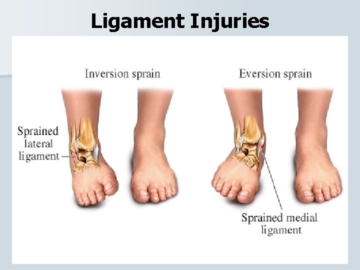 Ligament Injuries 