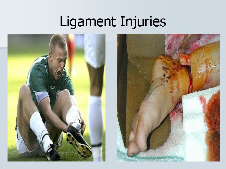 Ligament Injuries 