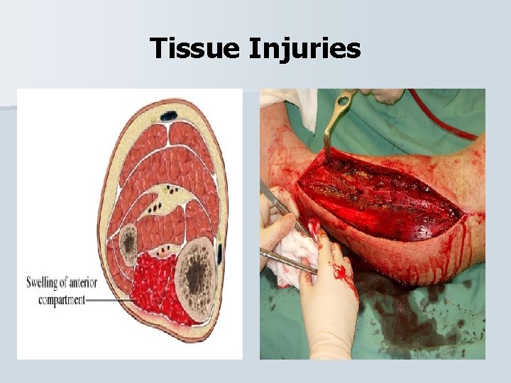 Tissue Injuries 