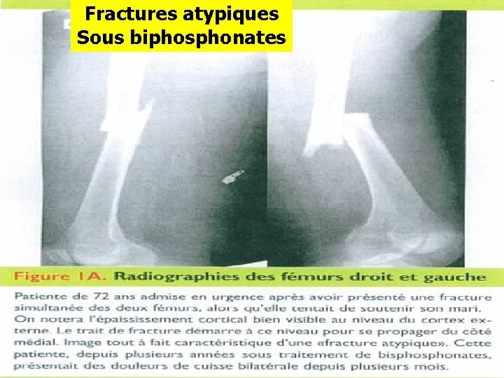 Fractures atypiques Sous biphosphonates 