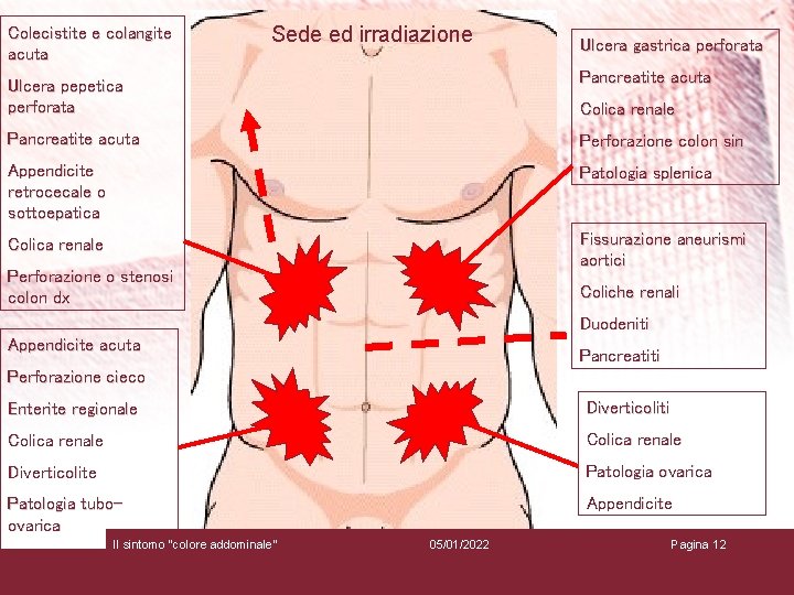 Colecistite e colangite acuta Sede ed irradiazione Ulcera gastrica perforata Ulcera pepetica perforata Pancreatite