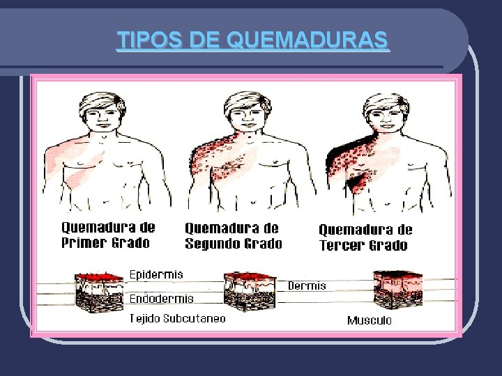 TIPOS DE QUEMADURAS 