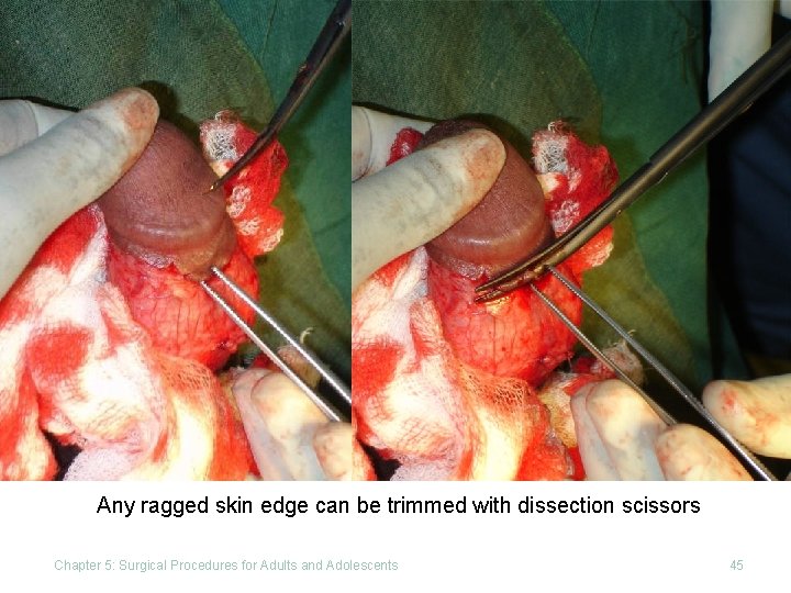 Click to edit Master title style Any ragged skin edge can be trimmed with