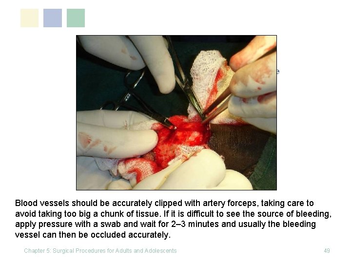 Click to edit Master title style Blood vessels should be accurately clipped with artery