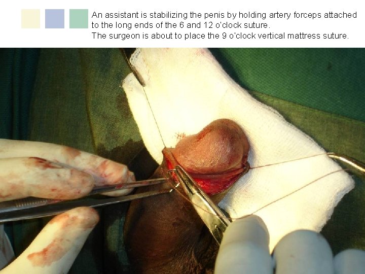 An assistant is stabilizing the penis by holding artery forceps attached to the long