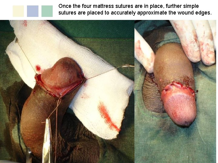 Once the four mattress sutures are in place, further simple sutures are placed to