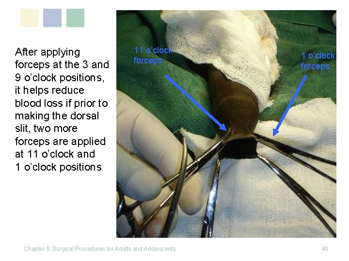 After applying forceps at the 3 and 9 o’clock positions, it helps reduce blood