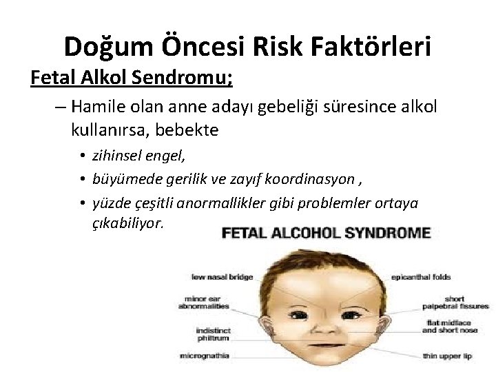 Doğum Öncesi Risk Faktörleri Fetal Alkol Sendromu; – Hamile olan anne adayı gebeliği süresince