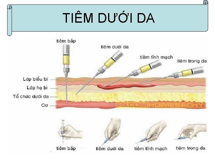 I. Tiªm trong da TIÊM DƯỚI DA 