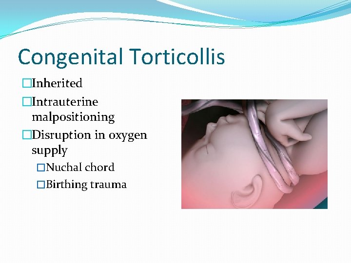 Congenital Torticollis �Inherited �Intrauterine malpositioning �Disruption in oxygen supply �Nuchal chord �Birthing trauma 