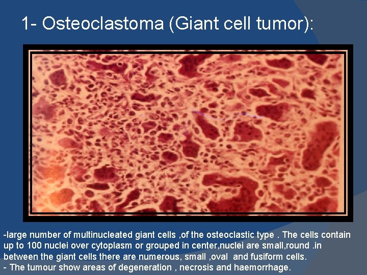 1 - Osteoclastoma (Giant cell tumor): -large number of multinucleated giant cells , of