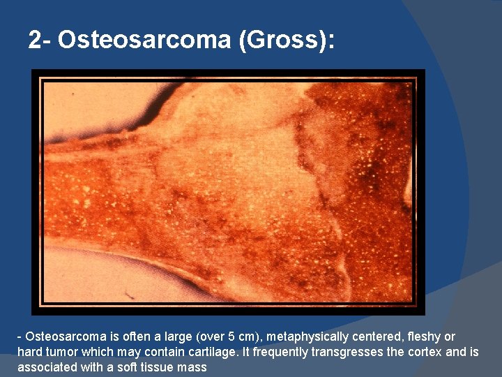 2 - Osteosarcoma (Gross): - Osteosarcoma is often a large (over 5 cm), metaphysically