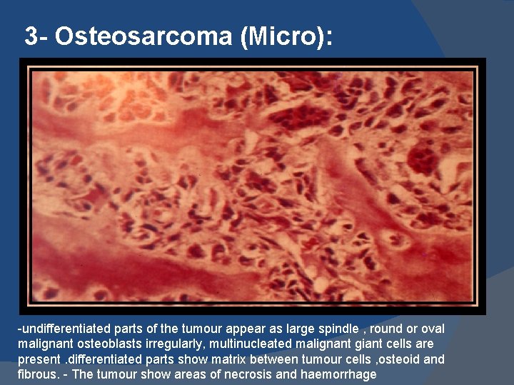 3 - Osteosarcoma (Micro): -undifferentiated parts of the tumour appear as large spindle ,