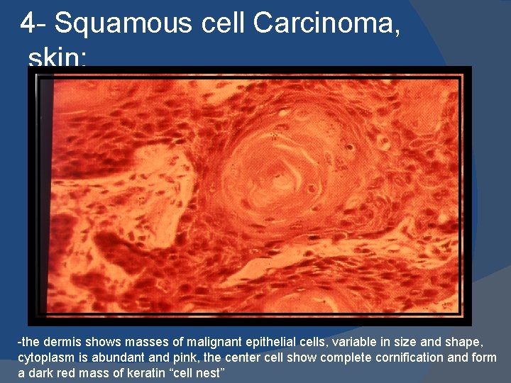 4 - Squamous cell Carcinoma, skin: -the dermis shows masses of malignant epithelial cells,